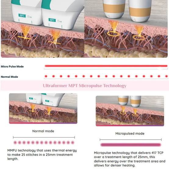 แนะนำนวัตกรรมยกกระชับผิวด้วยพลังงานคลื่นเสียง Hyperthermia Lifting Therapy: Ultraformer MPT Micro-Pulse Technology