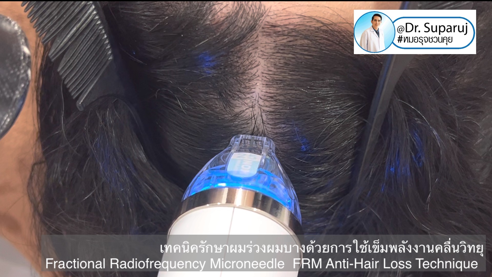 แนะนำเทคนิครักษาผมร่วงผมบาง: เทคนิครักษาผมร่วงผมบางด้วยการใช้เข็มพลังงานคลื่นวิทยุ Fractional Radiofrequency Microneedle FRM Anti-Hair Loss Technique แนะนำเทคนิครักษาผมร่วงผมบาง: เทคนิครักษาผมร่วงผมบางด้วยการใช้เข็มพลังงานคลื่นวิทยุ Fractional Radiofrequency Microneedle FRM Anti-Hair Loss Technique