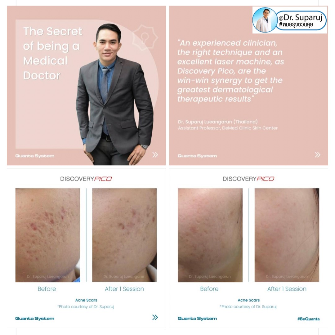 เทคนิคหลักการรักษาหลุมสิวด้วยเลเซอร์ Diacovery Pico Laser ของหมอรุจได้รับการเผยแพร่ในระดับนานาชาติของทางบริษัทระดับโลก Quanta System จากประเทศอิตาลีครับ เทคนิคหลักการรักษาหลุมสิวด้วยเลเซอร์ Diacovery Pico Laser ของหมอรุจได้รับการเผยแพร่ในระดับนานาชาติของทางบริษัทระดับโลก Quanta System จากประเทศอิตาลีครับ