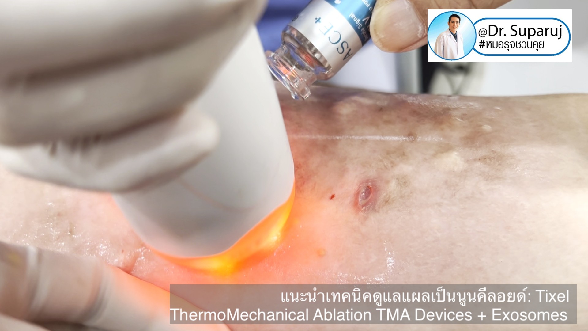 แนะนำเทคนิคดูแลแผลเป็นนูนคีลอยด์: รักษาแผลเป็นนูนด้วยทิกเซลล์ Tixel Fractional ThermoMechanical Ablation Devices + Exosomes แนะนำเทคนิคดูแลแผลเป็นนูนคีลอยด์: รักษาแผลเป็นนูนด้วยทิกเซลล์ Tixel Fractional ThermoMechanical Ablation Devices + Exosomes