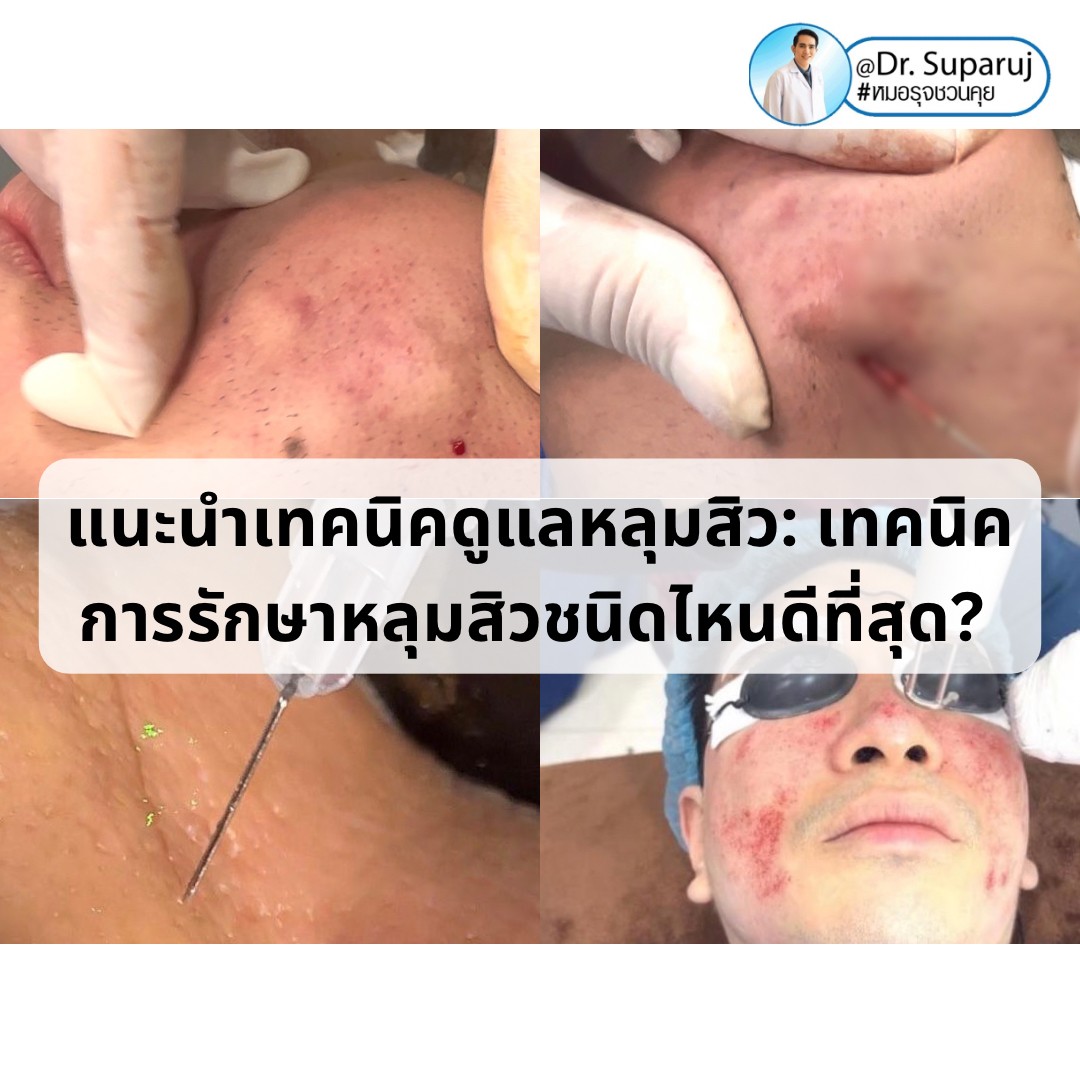 แนะนำเทคนิคดูแลหลุมสิว: เทคนิคการรักษาหลุมสิวชนิดไหนดีที่สุด? แนะนำเทคนิคดูแลหลุมสิว: เทคนิคการรักษาหลุมสิวชนิดไหนดีที่สุด?