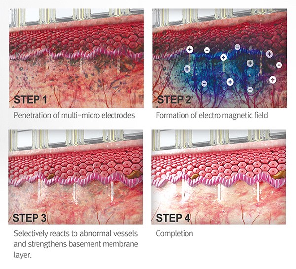 Update เทคนิคยกกระชับผิว หลุมสิว ดูแลปัญหาเม็ดสี ฝ้า+เส้นเลือด: SYLFIRM X นวัตกรรมคลื่นวิทยุแบบเข็ม (Fractional microneedle Radiofrequency) Update เทคนิคยกกระชับผิว หลุมสิว ดูแลปัญหาเม็ดสี ฝ้า+เส้นเลือด: SYLFIRM X นวัตกรรมคลื่นวิทยุแบบเข็ม (Fractional microneedle Radiofrequency)