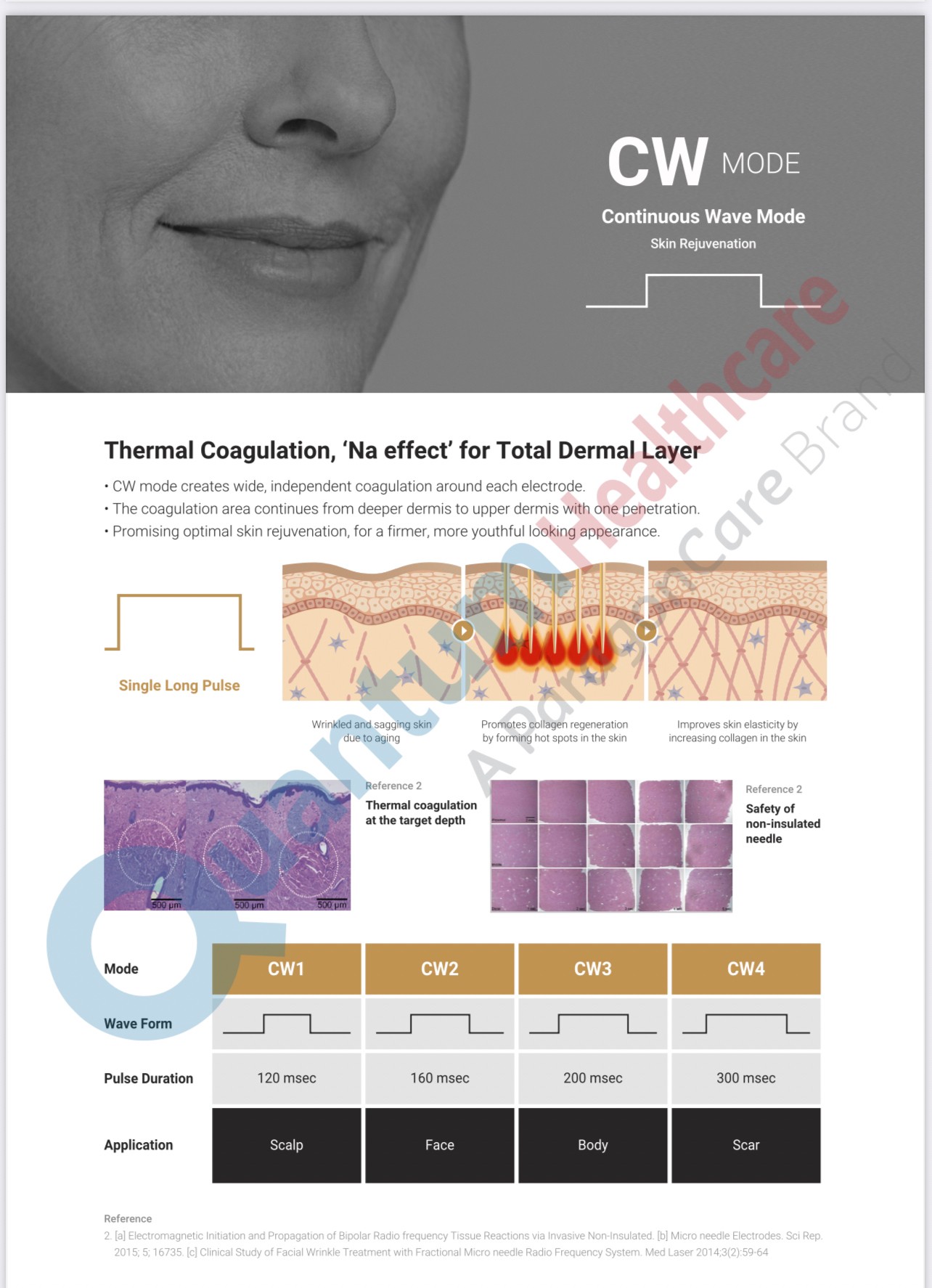 Update เทคนิคยกกระชับผิว หลุมสิว ดูแลปัญหาเม็ดสี ฝ้า+เส้นเลือด: SYLFIRM X นวัตกรรมคลื่นวิทยุแบบเข็ม (Fractional microneedle Radiofrequency) Update เทคนิคยกกระชับผิว หลุมสิว ดูแลปัญหาเม็ดสี ฝ้า+เส้นเลือด: SYLFIRM X นวัตกรรมคลื่นวิทยุแบบเข็ม (Fractional microneedle Radiofrequency)