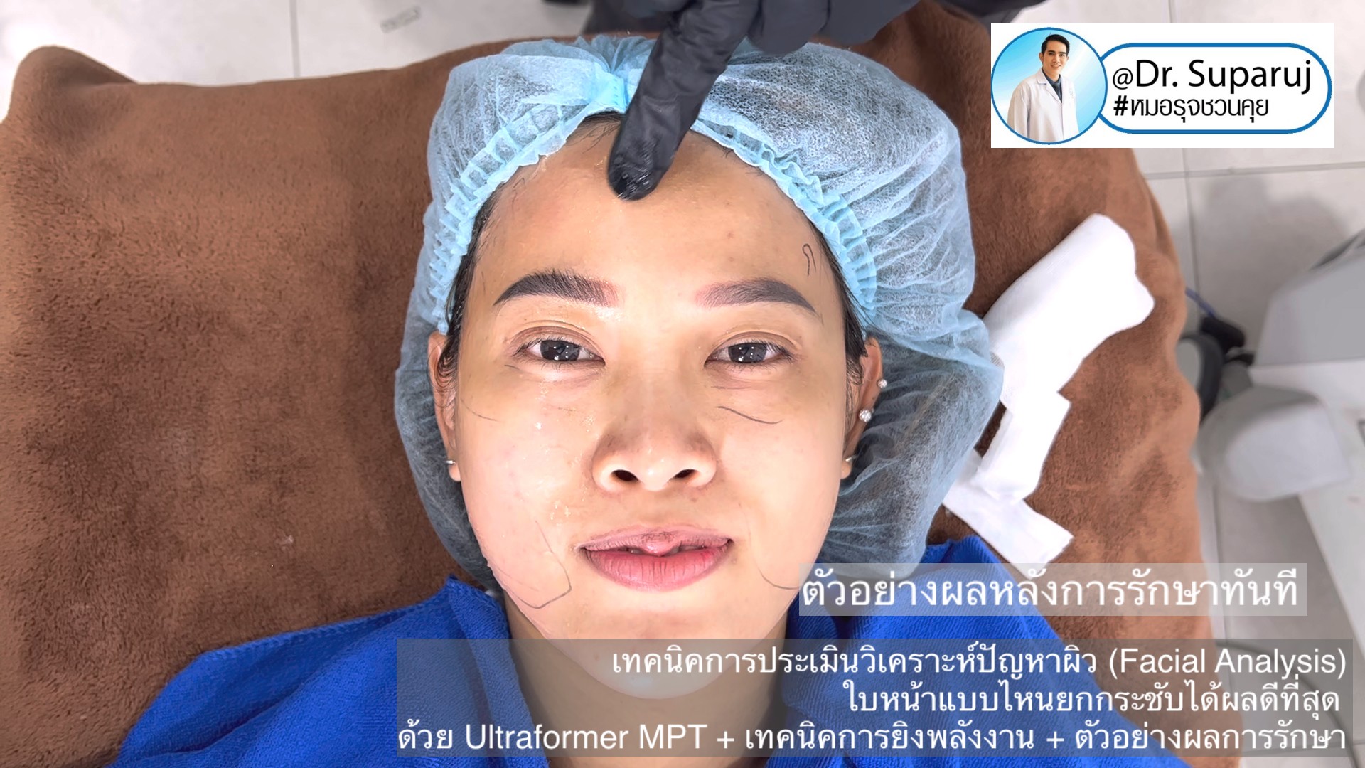  เทคนิคการประเมินวิเคราะห์ปัญหาผิว (Facial Analysis) ใบหน้าแบบไหนยกกระชับได้ผลดีที่สุด ด้วย Ultraformer MPT + เทคนิคการยิงพลังงาน + ตัวอย่างผลการรักษา