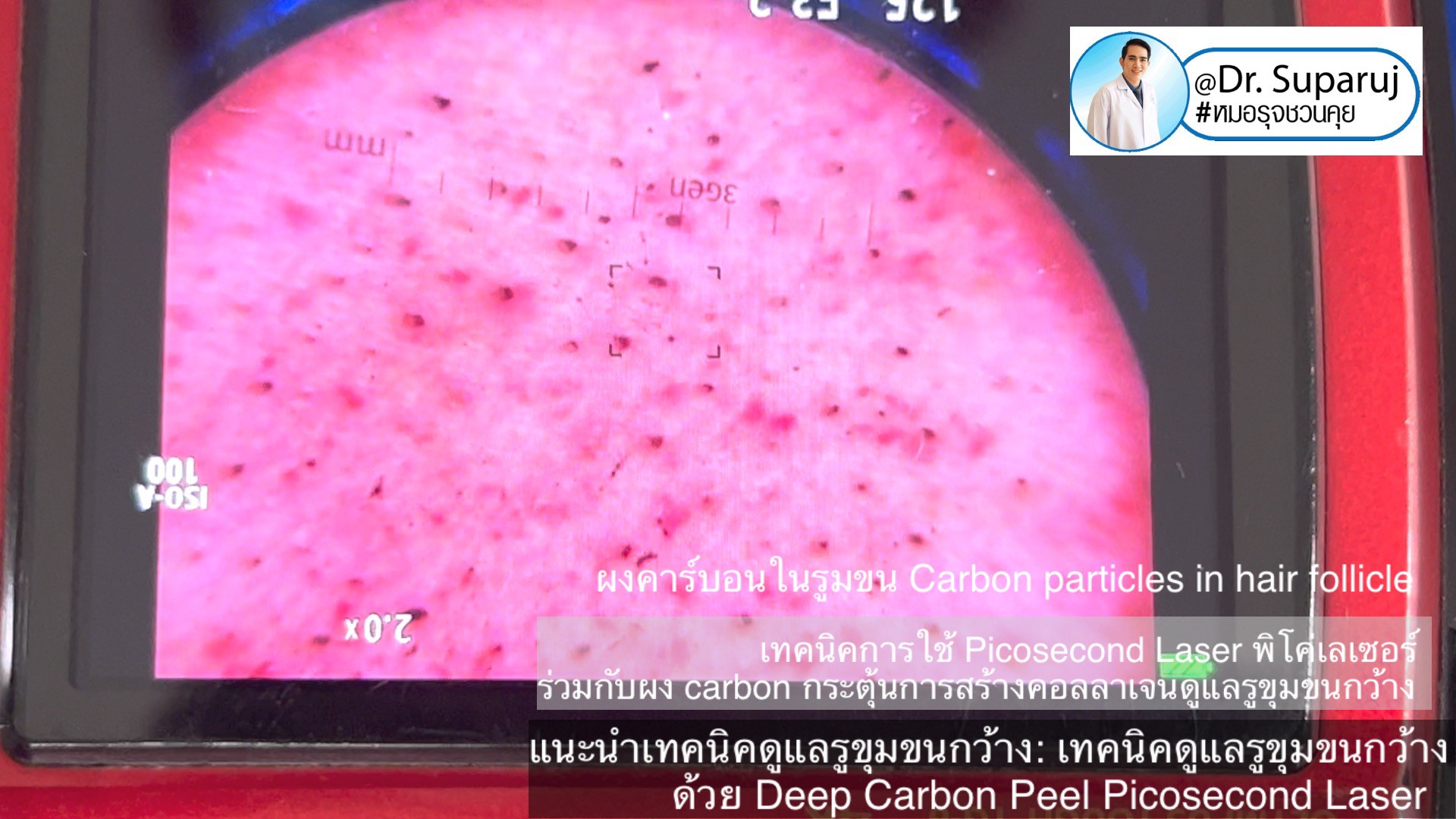 แนะนำเทคนิคดูแลรูขุมขนกว้าง: เทคนิคดูแลรูขุมขนกว้างด้วย Deep Carbon Peel Picosecond Laser (เทคนิคการใช้ Picosecond Laser พิโค่เลเซอร์ ร่วมกับผง carbon กระตุ้นการสร้างคอลลาเจนดูแลรูขุมขนกว้าง )