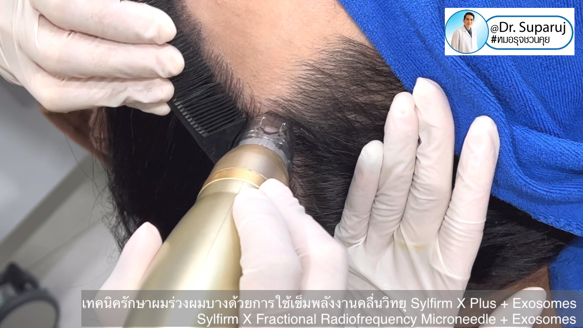 แนะนำ เทคนิครักษาผมร่วงผมบางด้วยการใช้เข็มพลังงานคลื่นวิทยุ Sylfirm X Plus + Exosomes (Sylfirm X Fractional Radiofrequency Microneedle + Exosomes) แนะนำ เทคนิครักษาผมร่วงผมบางด้วยการใช้เข็มพลังงานคลื่นวิทยุ Sylfirm X Plus + Exosomes (Sylfirm X Fractional Radiofrequency Microneedle + Exosomes)