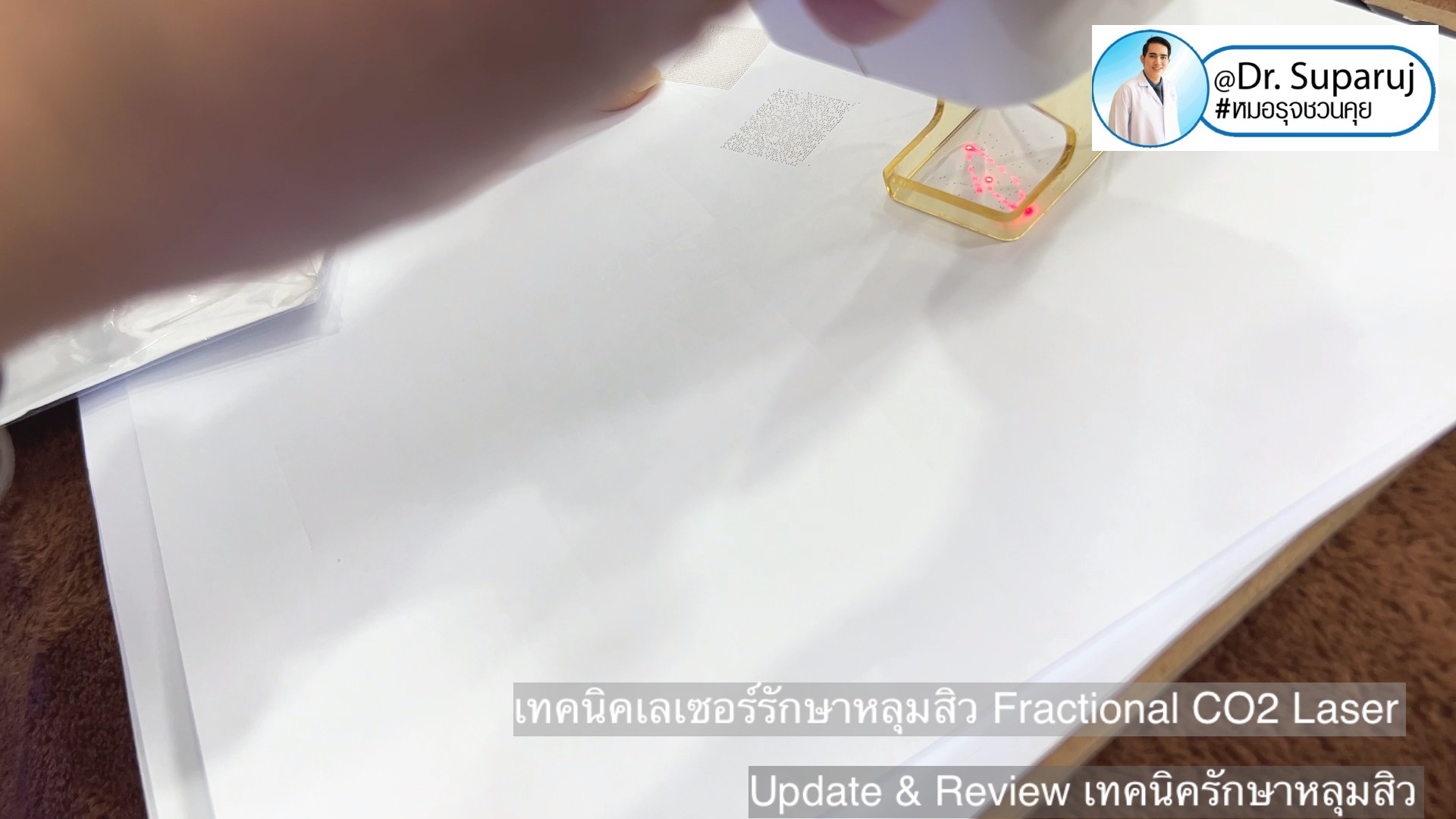 Update & Review เทคนิครักษาหลุมสิว (Acne Scar Treatment: Update & Review) Update & Review เทคนิครักษาหลุมสิว (Acne Scar Treatment: Update & Review)