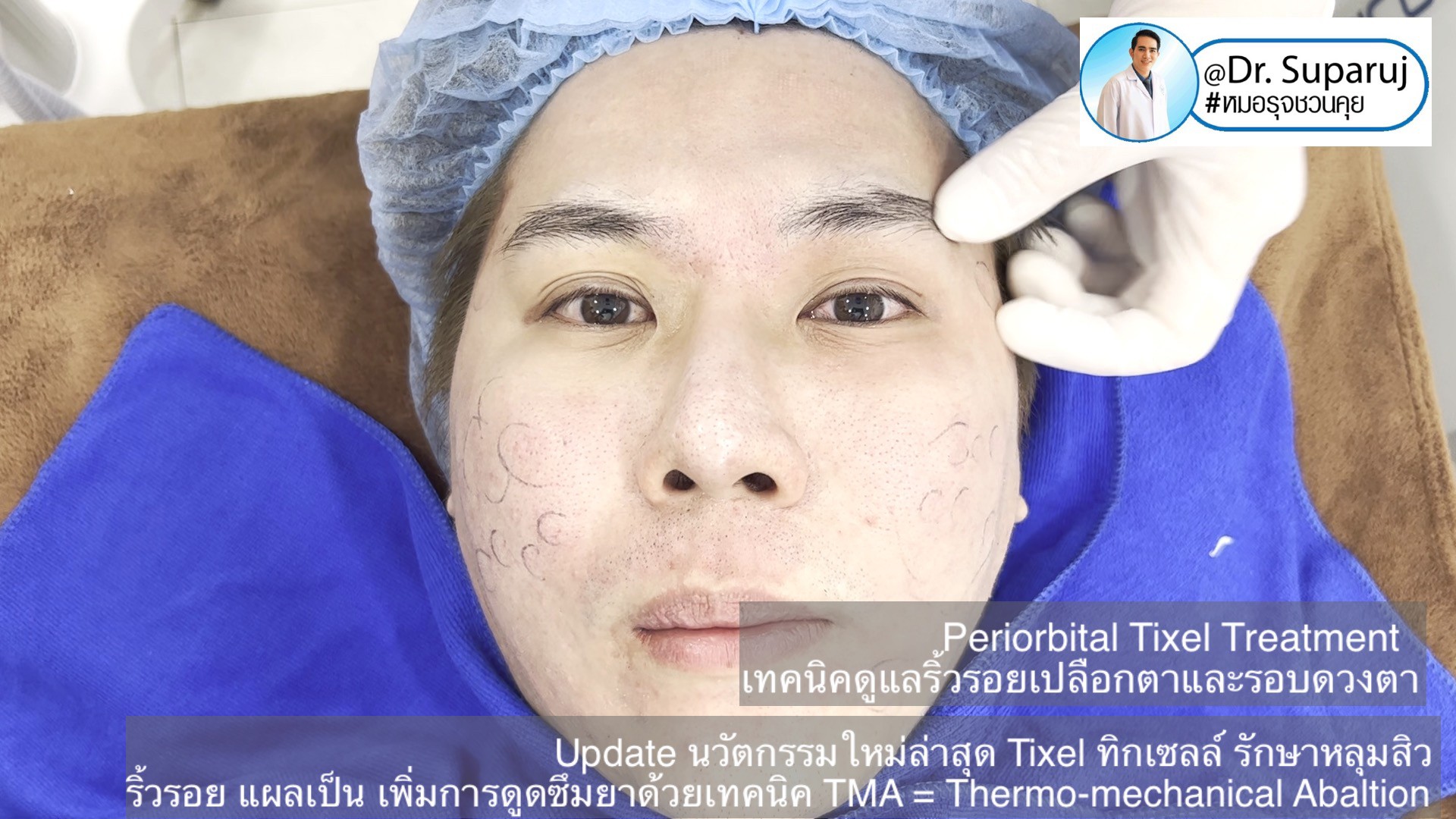 Update นวัตกรรมใหม่ล่าสุด Tixel ทิ๊กเซลล์ รักษาหลุมสิว ริ้วรอย แผลเป็น + Periorbital Tixel Treatment ดูแลริ้วรอยเปลือกตาและรอบดวงตาด้วยเทคนิค TMA = Thermo-mechanical Abaltion Update นวัตกรรมใหม่ล่าสุด Tixel ทิ๊กเซลล์ รักษาหลุมสิว ริ้วรอย แผลเป็น + Periorbital Tixel Treatment ดูแลริ้วรอยเปลือกตาและรอบดวงตาด้วยเทคนิค TMA = Thermo-mechanical Abaltion