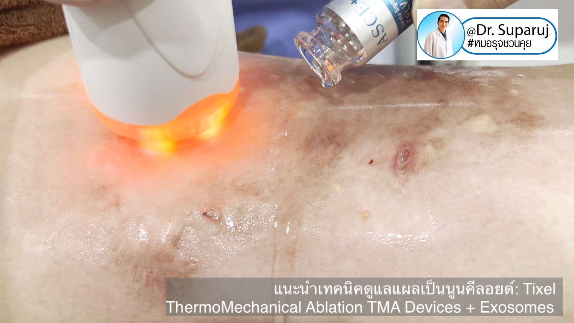 แนะนำเทคนิคดูแลแผลเป็นนูนคีลอยด์: รักษาแผลเป็นนูนด้วยทิกเซลล์ Tixel Fractional ThermoMechanical Ablation Devices + Exosomes แนะนำเทคนิคดูแลแผลเป็นนูนคีลอยด์: รักษาแผลเป็นนูนด้วยทิกเซลล์ Tixel Fractional ThermoMechanical Ablation Devices + Exosomes