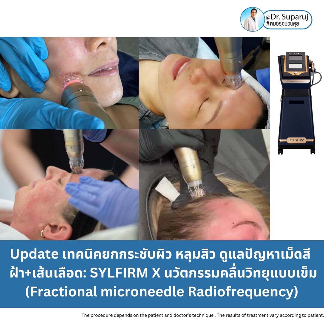 Update เทคนิคยกกระชับผิว หลุมสิว ดูแลปัญหาเม็ดสี ฝ้า+เส้นเลือด ด้วยนวัตกรรมคลื่นวิทยุแบบเข็ม Fractional microneedle Radiofrequency : SYLFIRM X Update เทคนิคยกกระชับผิว หลุมสิว ดูแลปัญหาเม็ดสี ฝ้า+เส้นเลือด ด้วยนวัตกรรมคลื่นวิทยุแบบเข็ม Fractional microneedle Radiofrequency : SYLFIRM X