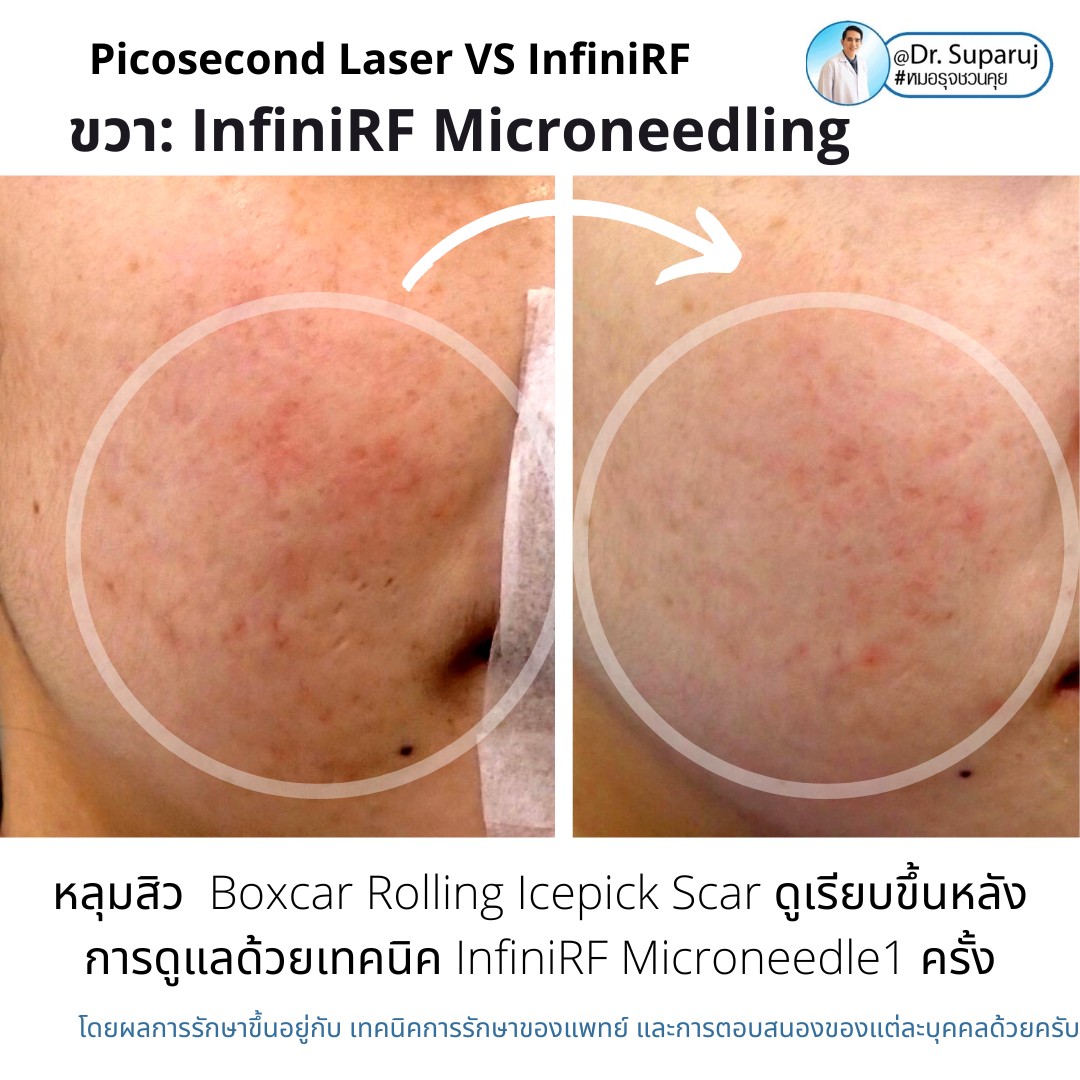แนะนำเทคนิครักษาหลุมสิว: ดูแลหลุมสิวด้วยเข็มพลังงานคลื่นวิทยุ Infini RF Microneedle แนะนำเทคนิครักษาหลุมสิว: ดูแลหลุมสิวด้วยเข็มพลังงานคลื่นวิทยุ Infini RF Microneedle