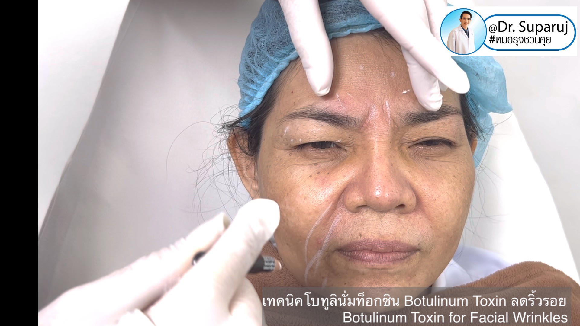 เทคนิคโบทูลินั่มท็อกซิน Botulinum Toxin ลดริ้วรอย Botulinum Toxin for Facial Wrinkles