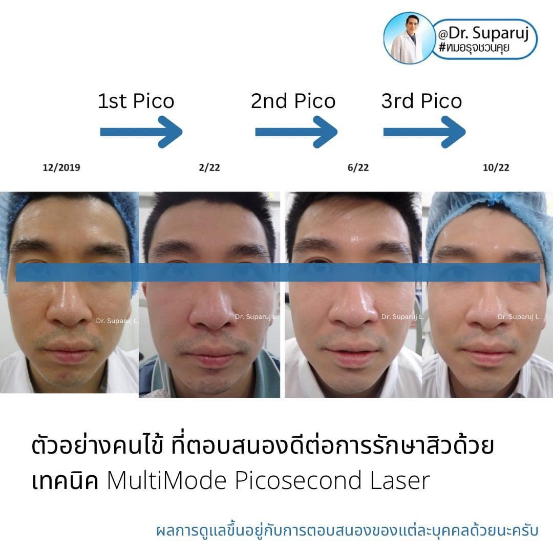 เป็นหลุมสิว แต่ยังไม่พร้อมรักษาหลุมสิว ทำอย่างไรดี? (+ เทคนิคการ เลือกใช้วิธีรักษาลุมสิวเบื้องต้นครับ) เป็นหลุมสิว แต่ยังไม่พร้อมรักษาหลุมสิว ทำอย่างไรดี? (+ เทคนิคการ เลือกใช้วิธีรักษาลุมสิวเบื้องต้นครับ)