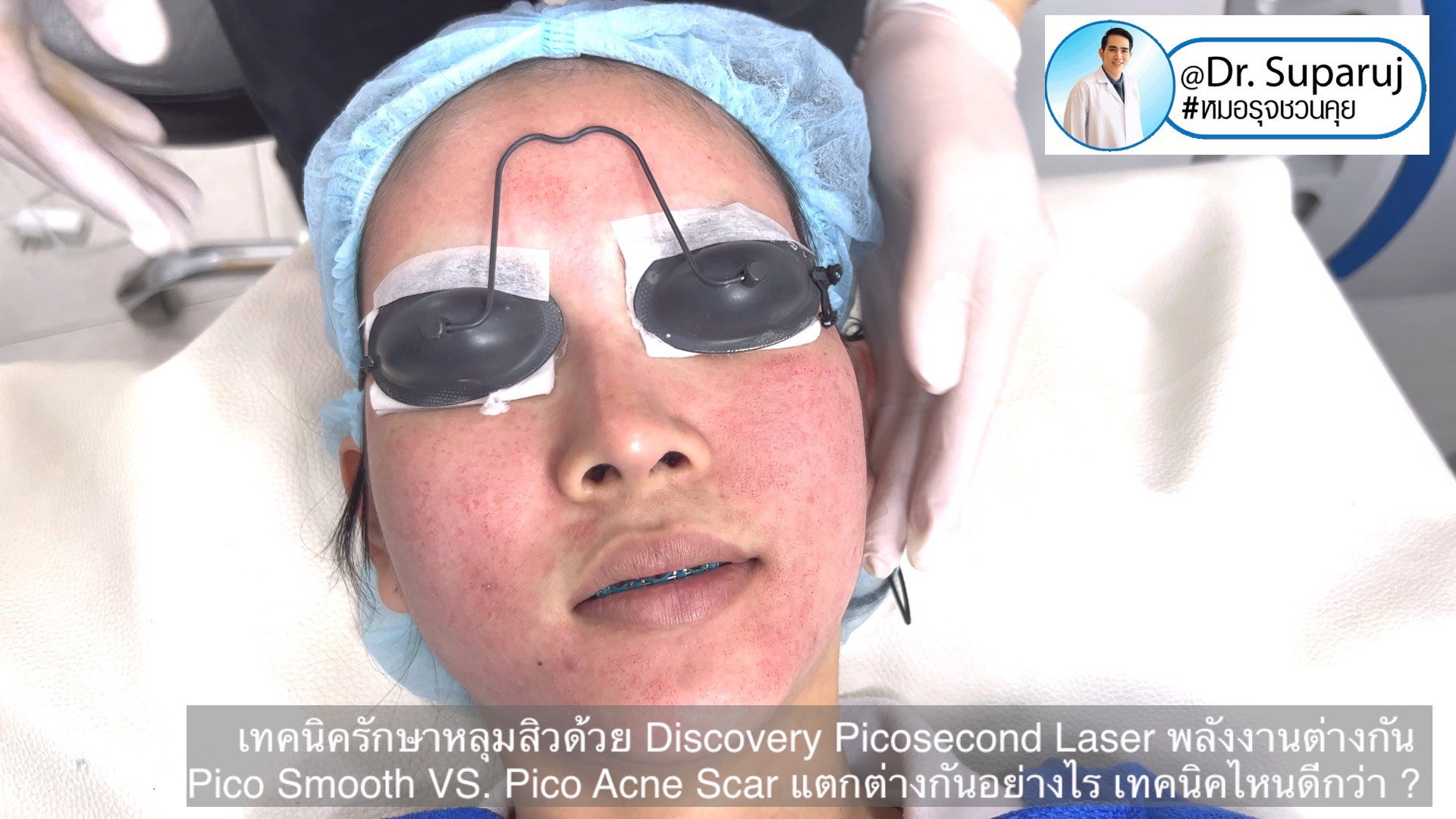 Q:Picosecond Laser หลุมสิวต้องยิงให้เลือดสาดไหม?