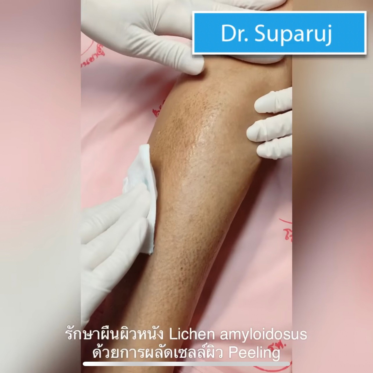 แนะนำการดูแลปัญหาโรคผิวหนัง: โรค Lichen amyloidosis ไลเค่น อะไมลอยโดซิส มีลักษณะอย่างไร ดูแลได้อย่างไร ? แนะนำการดูแลปัญหาโรคผิวหนัง: โรค Lichen amyloidosis ไลเค่น อะไมลอยโดซิส มีลักษณะอย่างไร ดูแลได้อย่างไร ?