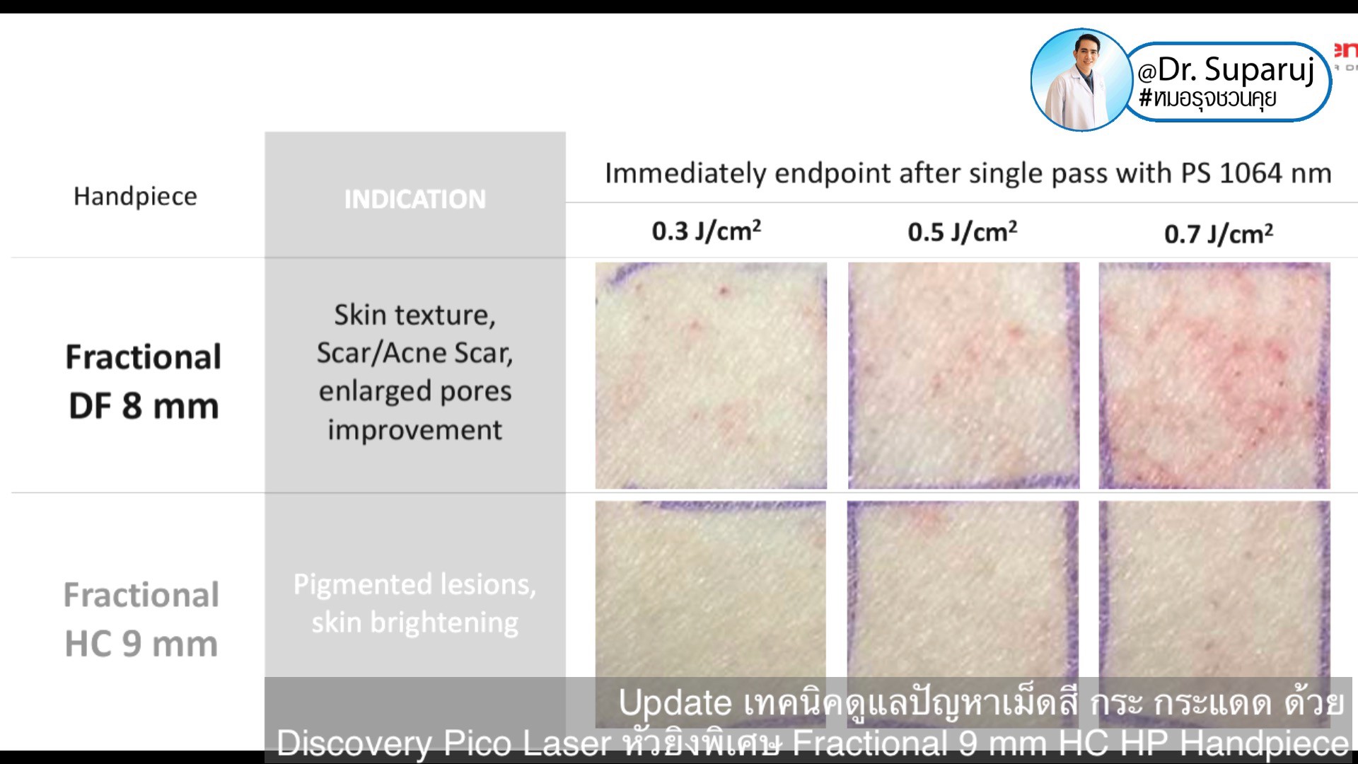 Update เทคนิคดูแลปัญหาเม็ดสี กระ กระแดด ด้วย Discovery Pico Laser หัวยิงเลเซอร์พิเศษ Fractional 9 mm HC HP Handpiece Update เทคนิคดูแลปัญหาเม็ดสี กระ กระแดด ด้วย Discovery Pico Laser หัวยิงเลเซอร์พิเศษ Fractional 9 mm HC HP Handpiece