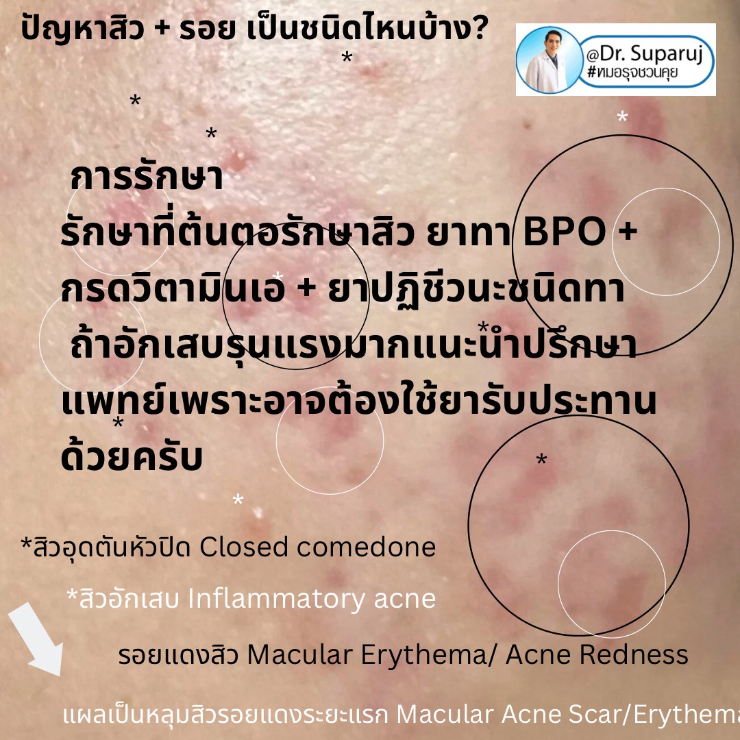 ปัญหาสิว + รอย เป็นชนิดไหนบ้าง? ปัญหาสิว + รอย เป็นชนิดไหนบ้าง?