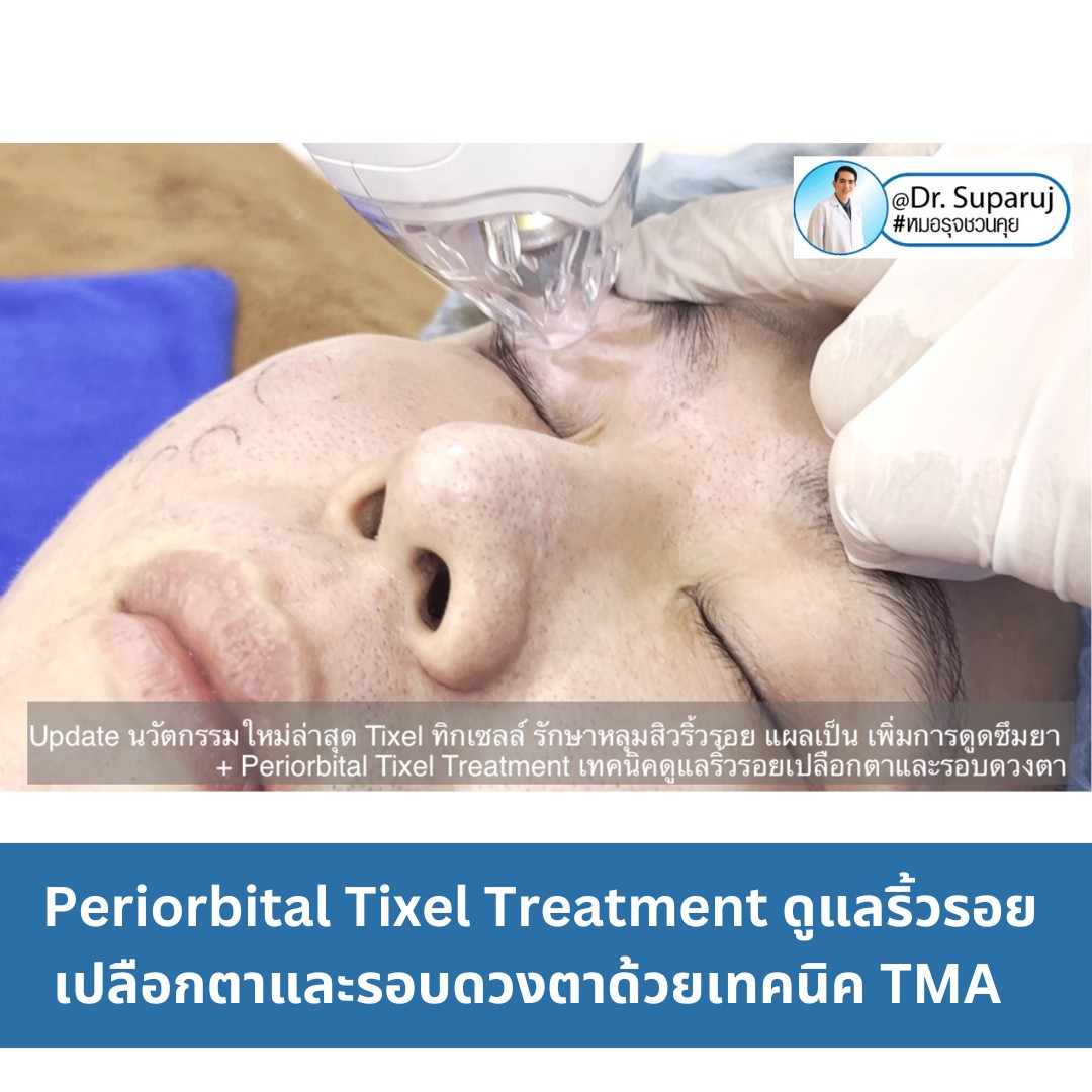 แนะนำเทคนิครักษาหลุมสิวและสิวอักเสบ: ประเมินชนิดความรุนแรงหลุมสิว + เทคโนโลยี Tixel ทิกเซล+ Exosomes แนะนำเทคนิครักษาหลุมสิวและสิวอักเสบ: ประเมินชนิดความรุนแรงหลุมสิว + เทคโนโลยี Tixel ทิกเซล+ Exosomes