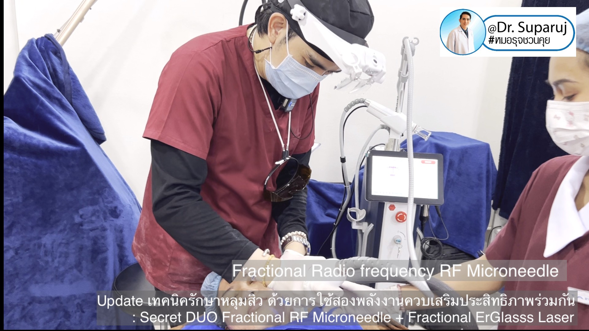 Update เทคนิครักษาหลุมสิว ด้วยการใช้สองพลังงานเสริมประสิทธิภาพร่วมกัน: Secret DUO Fractional RF Microneedle + Fractional ErGlasss Laser