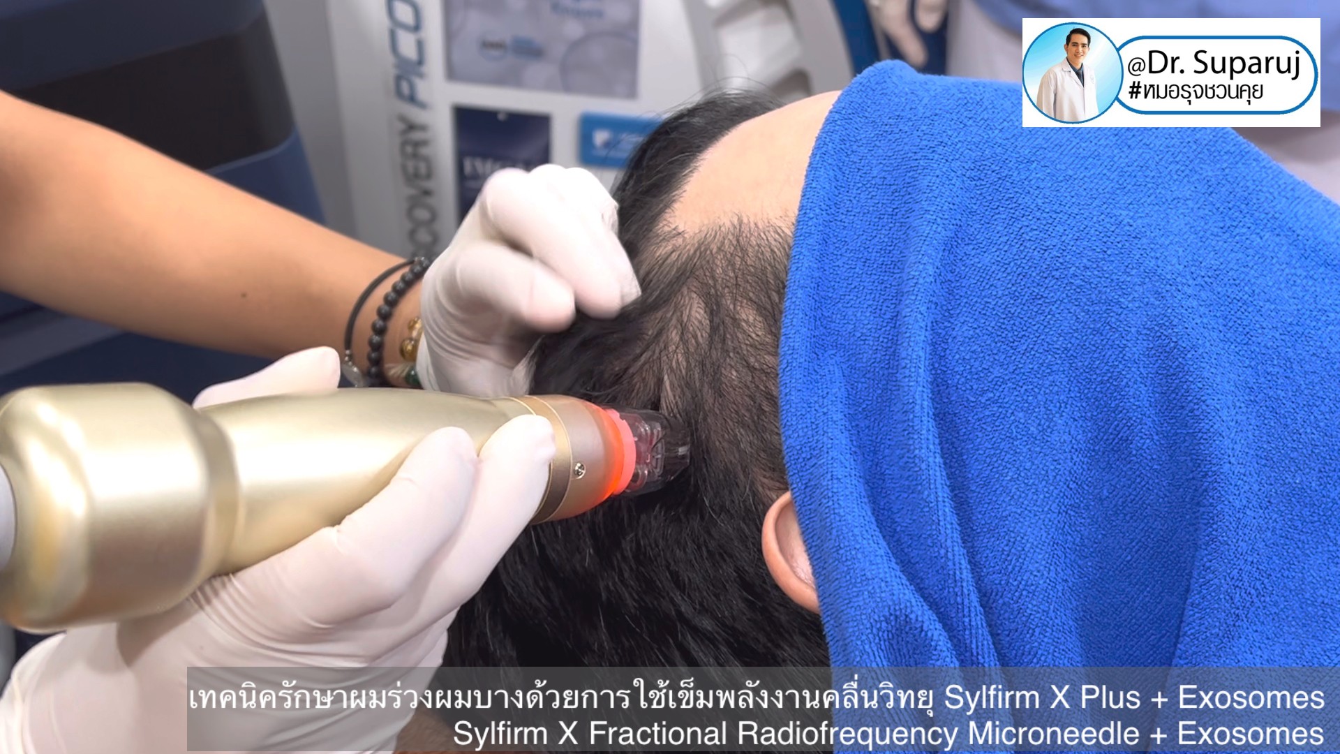 แนะนำ เทคนิครักษาผมร่วงผมบางด้วยการใช้เข็มพลังงานคลื่นวิทยุ Sylfirm X Plus + Exosomes (Sylfirm X Fractional Radiofrequency Microneedle + Exosomes) แนะนำ เทคนิครักษาผมร่วงผมบางด้วยการใช้เข็มพลังงานคลื่นวิทยุ Sylfirm X Plus + Exosomes (Sylfirm X Fractional Radiofrequency Microneedle + Exosomes)