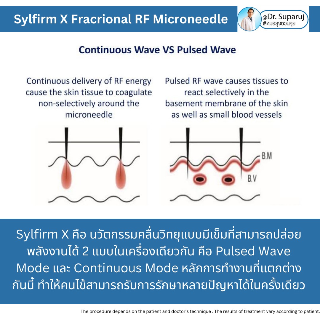 แนะนำเทคนิคดูแลแผลเป็นหลุมสิวด้วย SYLFIRM X Plus + Exosomes (SYLFIRM X Plus & Exosomes for Acne Scar Treatment) แนะนำเทคนิคดูแลแผลเป็นหลุมสิวด้วย SYLFIRM X Plus + Exosomes (SYLFIRM X Plus & Exosomes for Acne Scar Treatment)