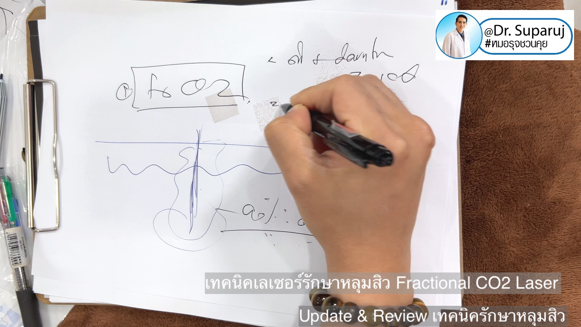 Update & Review เทคนิครักษาหลุมสิว (Acne Scar Treatment: Update & Review) Update & Review เทคนิครักษาหลุมสิว (Acne Scar Treatment: Update & Review)