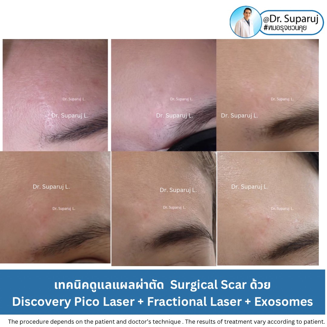 แนะนำเทคนิคดูแลแผลเป็นนูนคีลอยด์: รักษาแผลเป็นนูนด้วยทิกเซลล์ Tixel Fractional ThermoMechanical Ablation Devices + Exosomes แนะนำเทคนิคดูแลแผลเป็นนูนคีลอยด์: รักษาแผลเป็นนูนด้วยทิกเซลล์ Tixel Fractional ThermoMechanical Ablation Devices + Exosomes