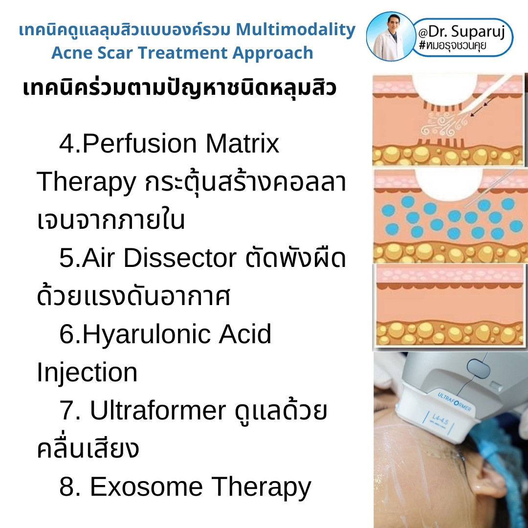 แนะนำเทคนิคดูแลหลุมสิว: เทคนิคการรักษาหลุมสิวชนิดไหนดีที่สุด?