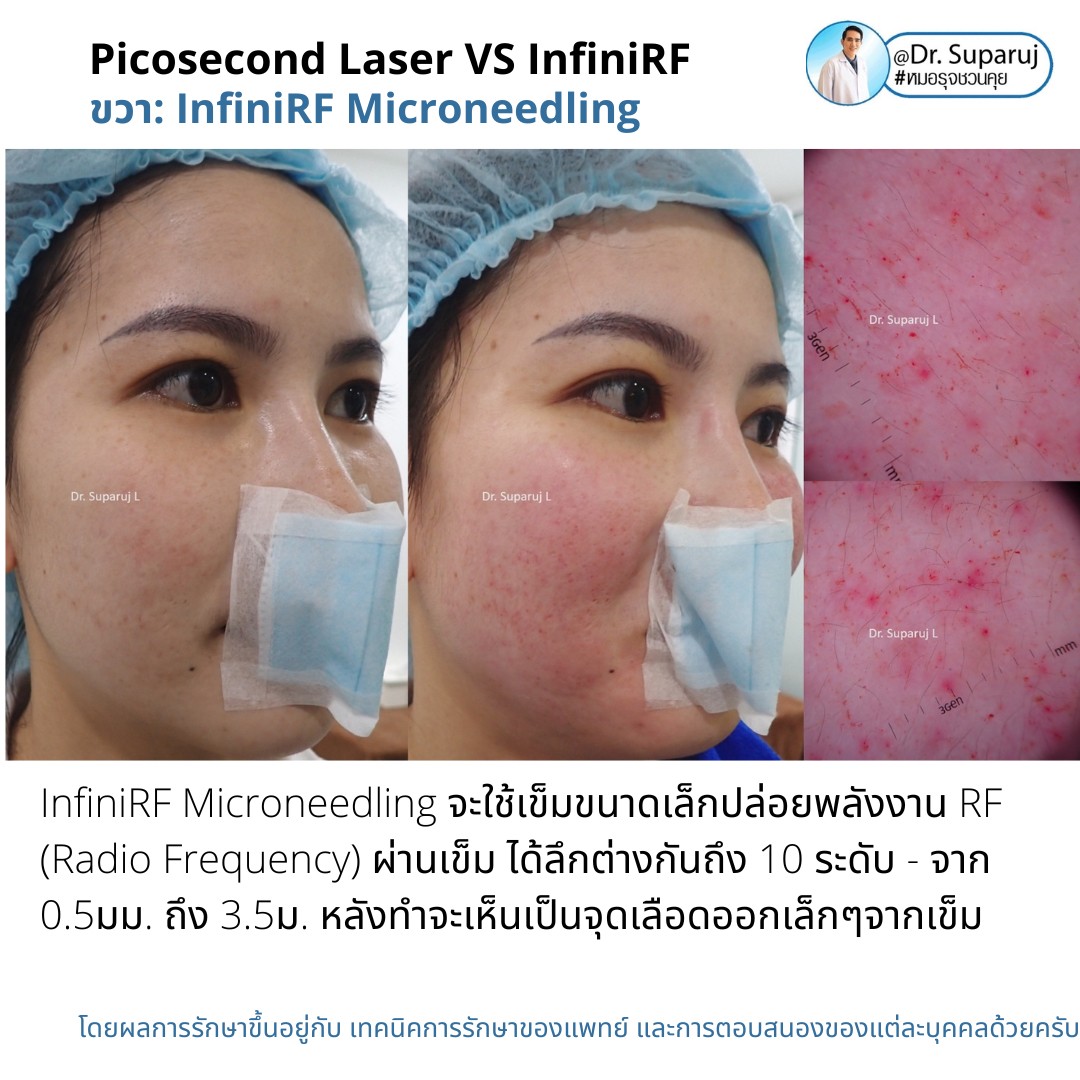 แนะนำเทคนิครักษาหลุมสิว: ดูแลหลุมสิวด้วยเข็มพลังงานคลื่นวิทยุ Infini RF Microneedle แนะนำเทคนิครักษาหลุมสิว: ดูแลหลุมสิวด้วยเข็มพลังงานคลื่นวิทยุ Infini RF Microneedle