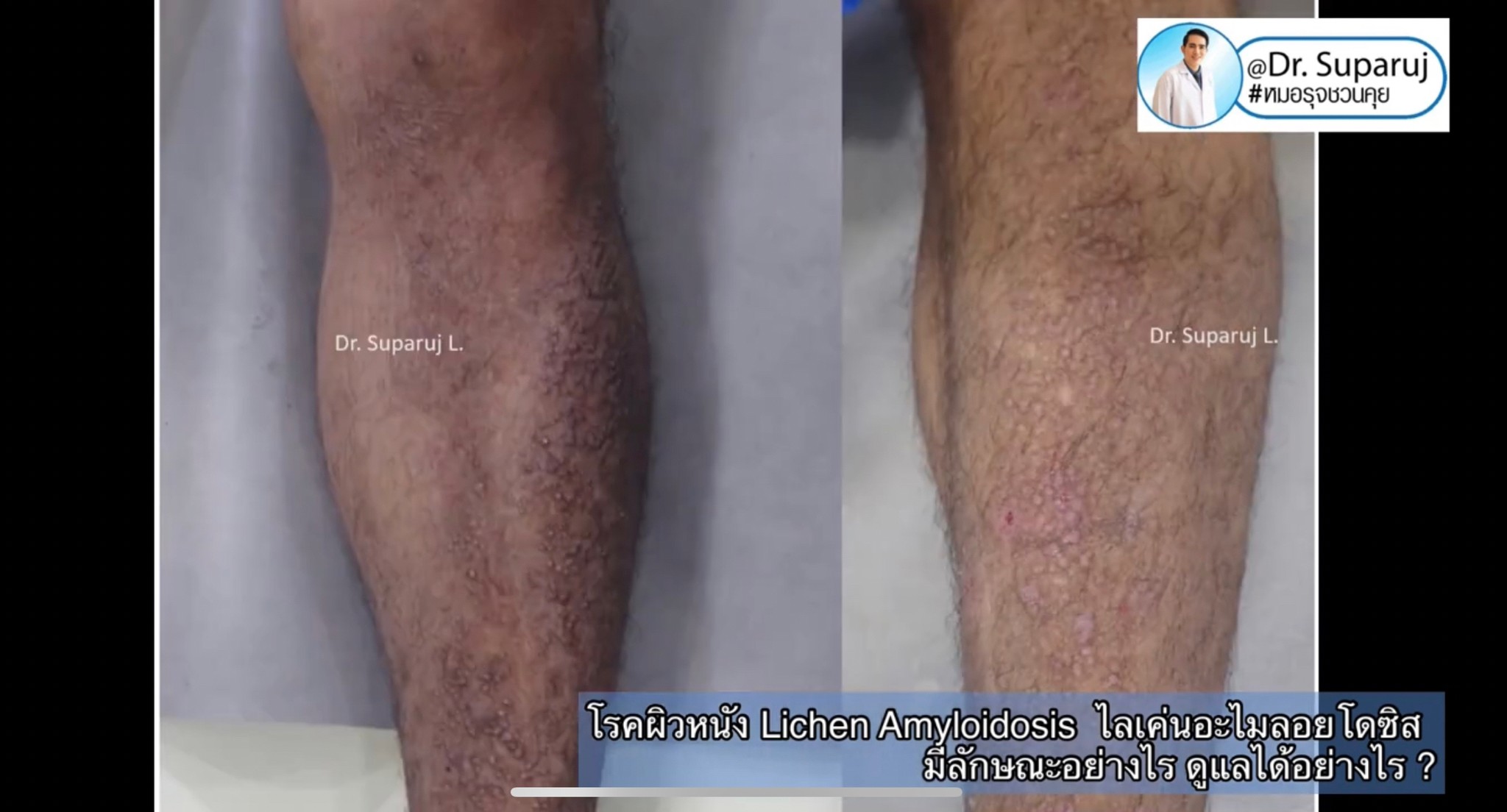 แนะนำการดูแลปัญหาโรคผิวหนัง: โรค Lichen amyloidosis ไลเค่น อะไมลอยโดซิส มีลักษณะอย่างไร ดูแลได้อย่างไร ? แนะนำการดูแลปัญหาโรคผิวหนัง: โรค Lichen amyloidosis ไลเค่น อะไมลอยโดซิส มีลักษณะอย่างไร ดูแลได้อย่างไร ?