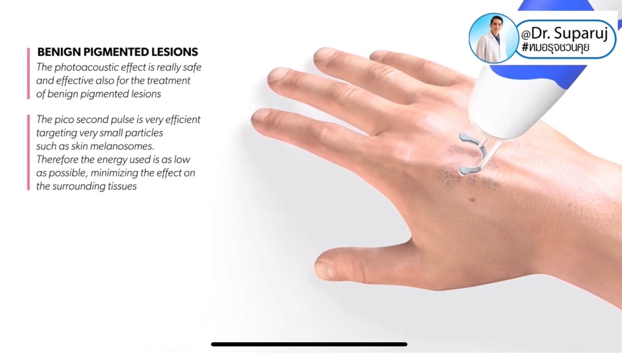 แนะนำเทคนิคดูแลริมฝีปากคล้ำ Lip Hyperpigmentation ริ้วรอย ริ้วรอยรอบริมฝีปาก: สาเหตุ การดูแล & เทคนิคเลเซอร์ MultiMode Discovery Picosecond Laser Lip Rejuvenation แนะนำเทคนิคดูแลริมฝีปากคล้ำ Lip Hyperpigmentation ริ้วรอย ริ้วรอยรอบริมฝีปาก: สาเหตุ การดูแล & เทคนิคเลเซอร์ MultiMode Discovery Picosecond Laser Lip Rejuvenation