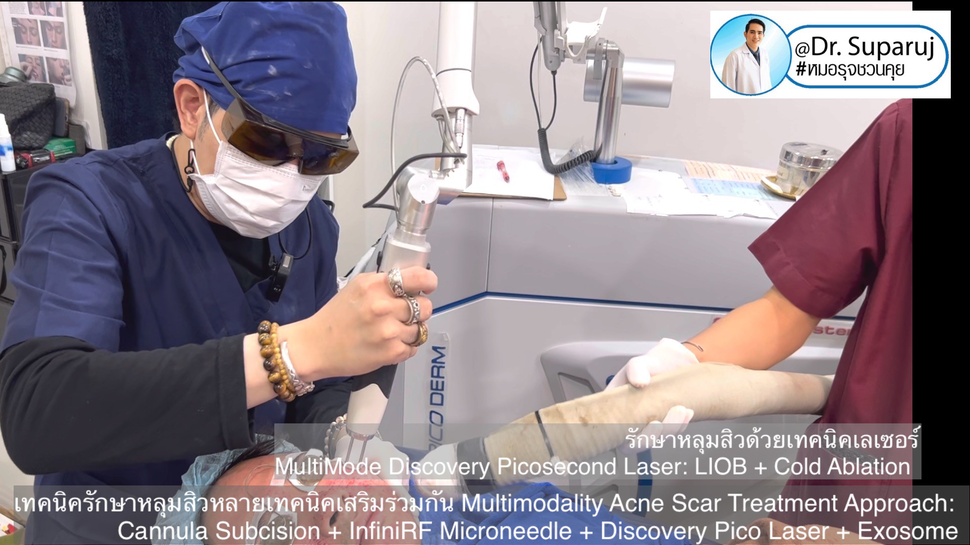 เทคนิครักษาหลุมสิวด้วยหลายเทคนิคเสริมร่วมกัน Multimodality Acne Scar Treatment Approach: Cannula Subcision + InfiniRF Microneedle + Discovery Pico Laser + Exosome