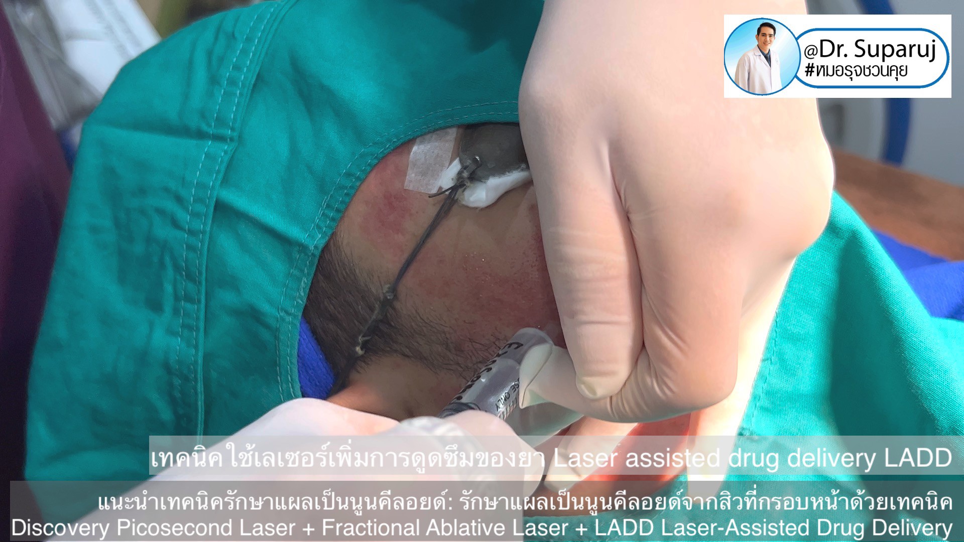 แนะนำเทคนิคดูแลแผลเป็นนูนคีลอยด์: รักษาแผลเป็นนูนคีลอยด์จากสิวที่กรอบหน้าด้วยเทคนิค Discovery Picosecond Laser + Fractional Ablative Laser + LADD Laser-Assisted Drug Delivery แนะนำเทคนิคดูแลแผลเป็นนูนคีลอยด์: รักษาแผลเป็นนูนคีลอยด์จากสิวที่กรอบหน้าด้วยเทคนิค Discovery Picosecond Laser + Fractional Ablative Laser + LADD Laser-Assisted Drug Delivery