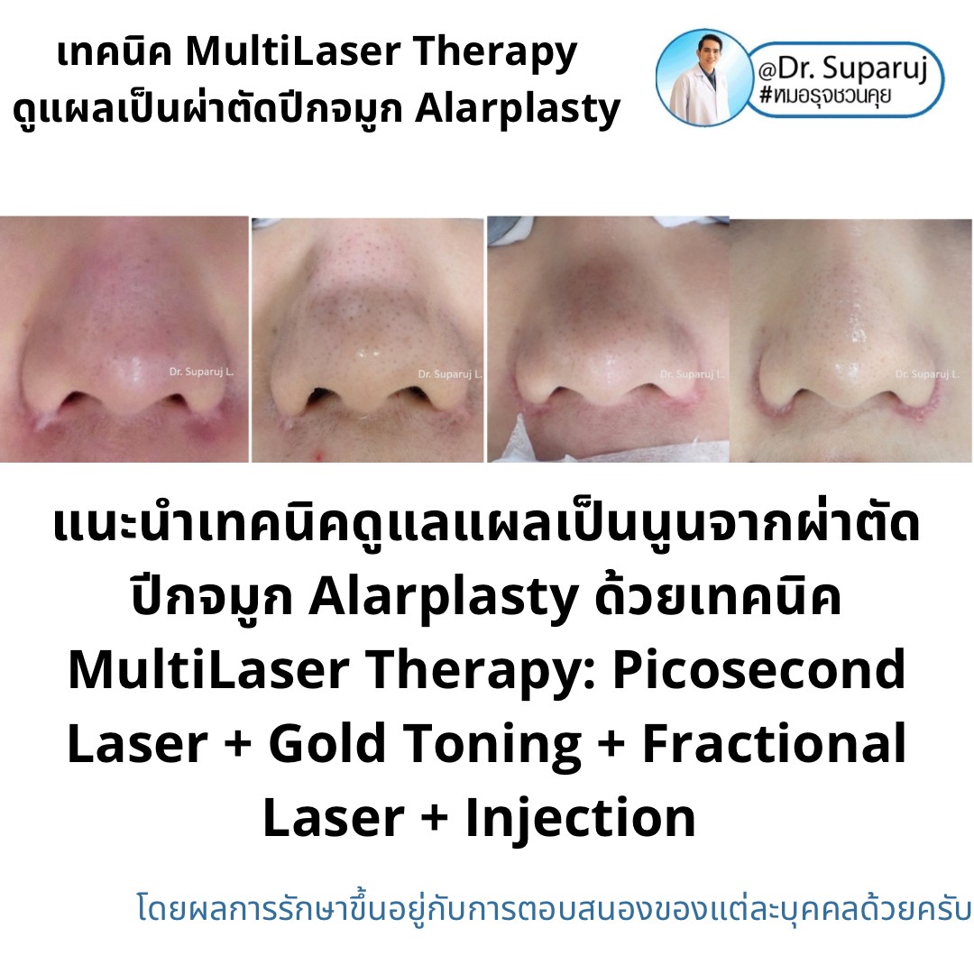 แนะนำเทคนิคดูแลแผลเป็นจากการผ่าตัด: ดูแลแผลเป็นนูนจากการผ่าตัดปีกจมูก Alarplasty ด้วยเทคนิค MultiLaser Therapy: Picosecond Laser + Gold Toning + Fractional Laser + Injection