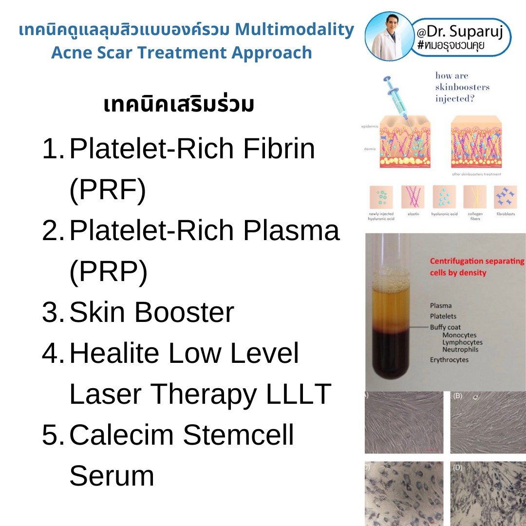 มีปัญหาหลุมสิว แต่ยังมีสิวขึ้นอยู่ สามารถรักษาหลุมสิวได้เลยไหม หรือควรดูแลอย่างไร? มีปัญหาหลุมสิว แต่ยังมีสิวขึ้นอยู่ สามารถรักษาหลุมสิวได้เลยไหม หรือควรดูแลอย่างไร?