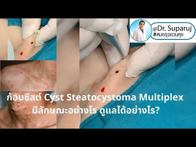 แนะนำเทคนิคดูแล ก้อนซีสต์จากท่อต่อมไขมัน Steatocystoma Multiplex (SM) ด้วย เข็มพลังงานคลื่นวิทยุ Insulated Radiofrequency RF Microneedle for Steatocystoma Multiplex Treatment แนะนำเทคนิคดูแล ก้อนซีสต์จากท่อต่อมไขมัน Steatocystoma Multiplex (SM) ด้วย เข็มพลังงานคลื่นวิทยุ Insulated Radiofrequency RF Microneedle for Steatocystoma Multiplex Treatment
