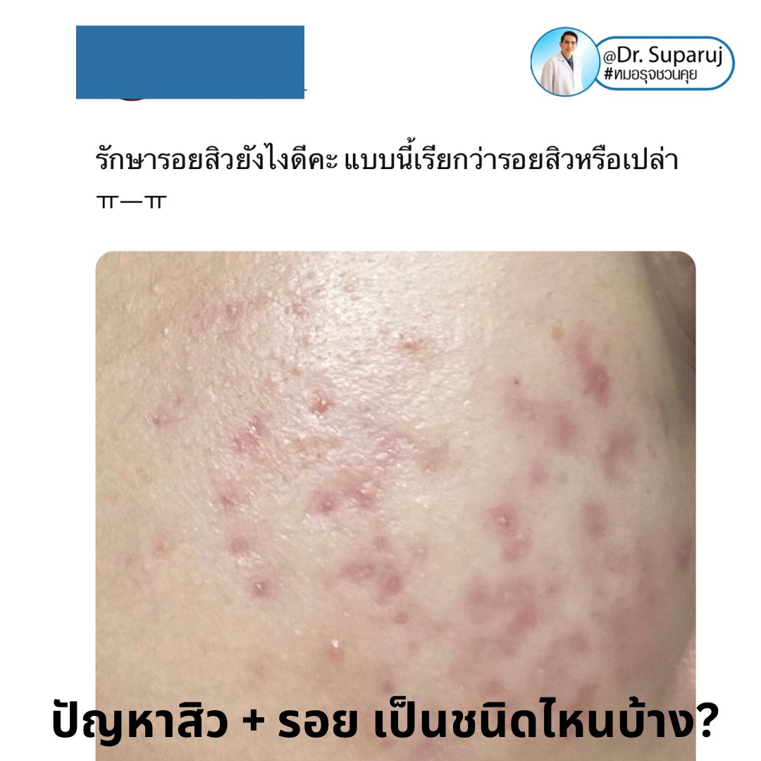 ปัญหาสิว + รอย เป็นชนิดไหนบ้าง? ปัญหาสิว + รอย เป็นชนิดไหนบ้าง?