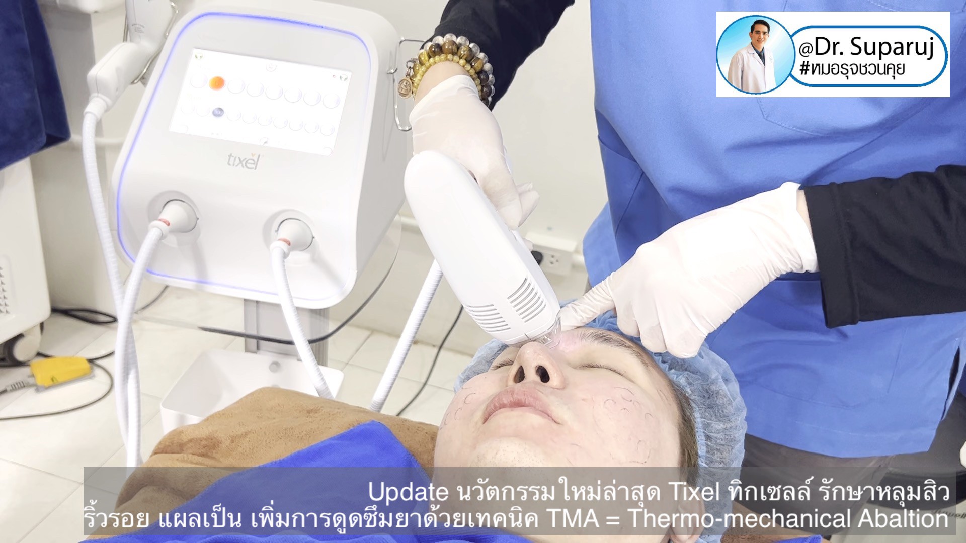 Update นวัตกรรมใหม่ล่าสุด Tixel ทิ๊กเซลล์ รักษาหลุมสิว ริ้วรอย แผลเป็น + Periorbital Tixel Treatment ดูแลริ้วรอยเปลือกตาและรอบดวงตาด้วยเทคนิค TMA = Thermo-mechanical Abaltion Update นวัตกรรมใหม่ล่าสุด Tixel ทิ๊กเซลล์ รักษาหลุมสิว ริ้วรอย แผลเป็น + Periorbital Tixel Treatment ดูแลริ้วรอยเปลือกตาและรอบดวงตาด้วยเทคนิค TMA = Thermo-mechanical Abaltion