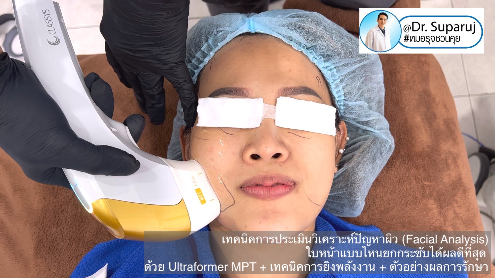  เทคนิคการประเมินวิเคราะห์ปัญหาผิว (Facial Analysis) ใบหน้าแบบไหนยกกระชับได้ผลดีที่สุด ด้วย Ultraformer MPT + เทคนิคการยิงพลังงาน + ตัวอย่างผลการรักษา
