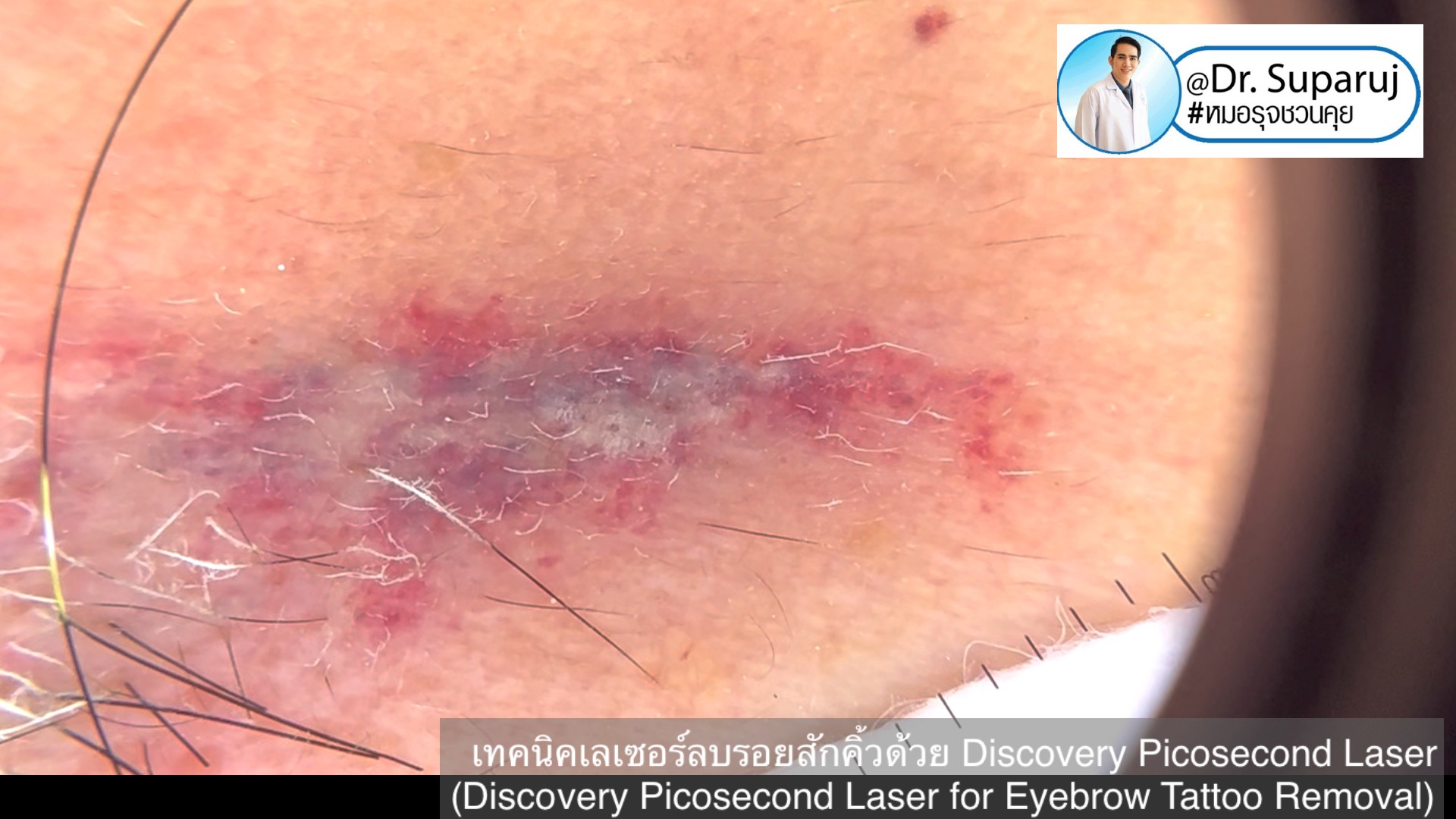 เทคนิคเลเซอร์ลบรอยสักคิ้วด้วย Discovery Picosecond Laser (Discovery Picosecond Laser for Eyebrow Tattoo Removal) เทคนิคเลเซอร์ลบรอยสักคิ้วด้วย Discovery Picosecond Laser (Discovery Picosecond Laser for Eyebrow Tattoo Removal)
