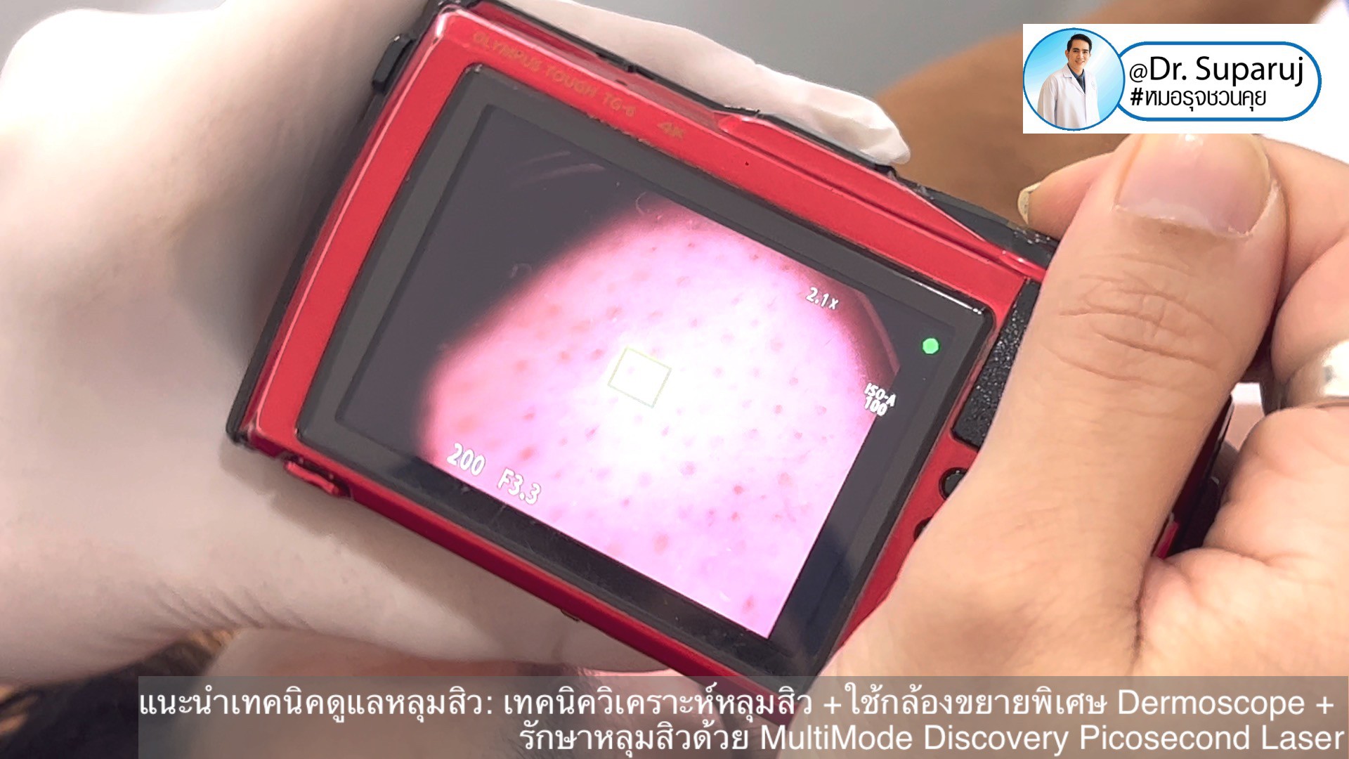 แนะนำเทคนิคดูแลหลุมสิว: เทคนิควิเคราะห์หลุมสิว +ใช้กล้องขยายพิเศษ Dermoscope + รักษาหลุมสิวด้วย MultiMode Discovery Picosecond Laser + Exosome Therapy