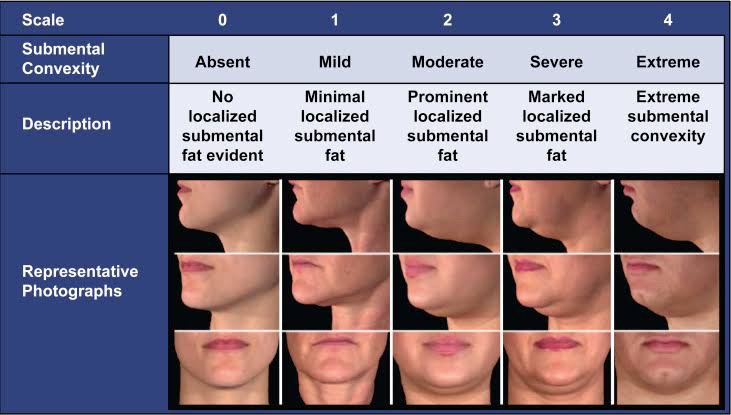 สาเหตุ & เทคนิคลดเหนียง ไขมันใต้คาง คาง 2 ชั้น Double Chin & Submental Fullness Treatment 