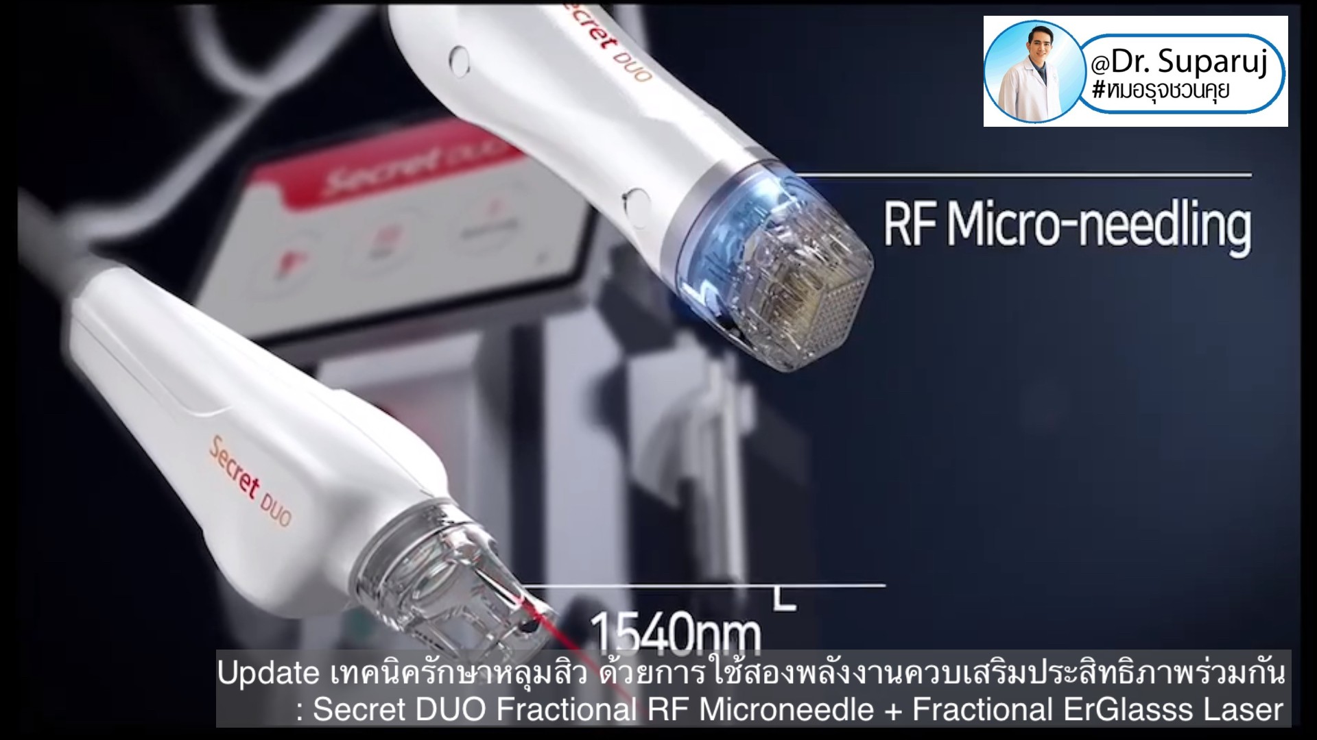 Update เทคนิครักษาหลุมสิว ด้วยการใช้สองพลังงานเสริมประสิทธิภาพร่วมกัน: Secret DUO Fractional RF Microneedle + Fractional ErGlasss Laser Update เทคนิครักษาหลุมสิว ด้วยการใช้สองพลังงานเสริมประสิทธิภาพร่วมกัน: Secret DUO Fractional RF Microneedle + Fractional ErGlasss Laser