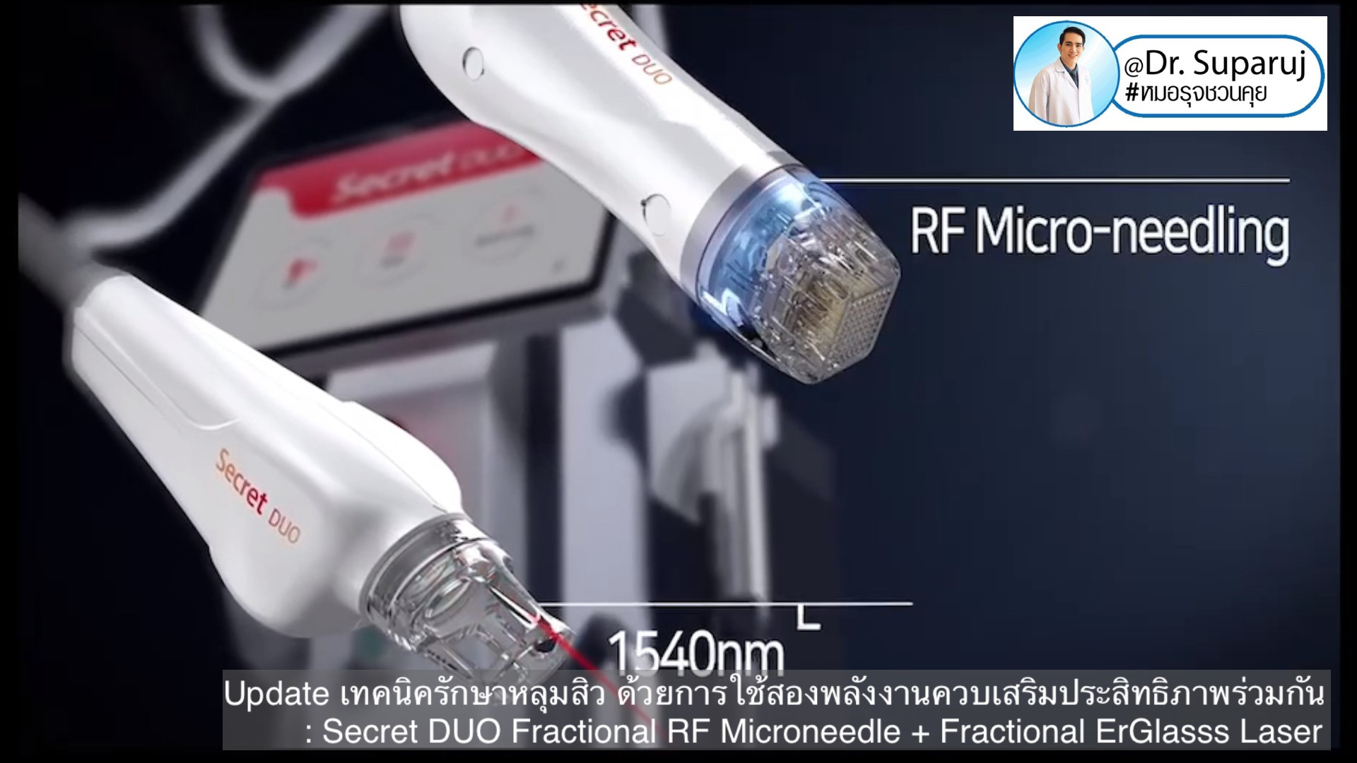 Update เทคนิครักษาหลุมสิว ด้วยการใช้สองพลังงานเสริมประสิทธิภาพร่วมกัน: Secret DUO Fractional RF Microneedle + Fractional ErGlasss Laser