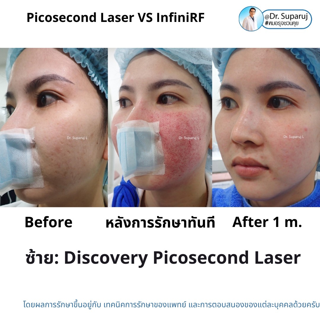 แนะนำเทคนิครักษาหลุมสิว: ดูแลหลุมสิวด้วยเข็มพลังงานคลื่นวิทยุ Infini RF Microneedle แนะนำเทคนิครักษาหลุมสิว: ดูแลหลุมสิวด้วยเข็มพลังงานคลื่นวิทยุ Infini RF Microneedle