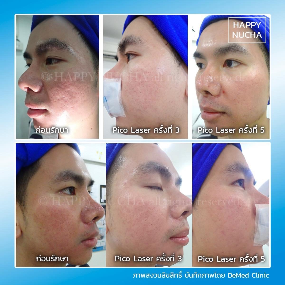 Update รักษาหลุมสิวด้วยเทคนิคการตัดพังผืด Blunt Blade Subcision (Blunt Blade Subcision for Acne Scar Fibrosis Treatment) Update รักษาหลุมสิวด้วยเทคนิคการตัดพังผืด Blunt Blade Subcision (Blunt Blade Subcision for Acne Scar Fibrosis Treatment)