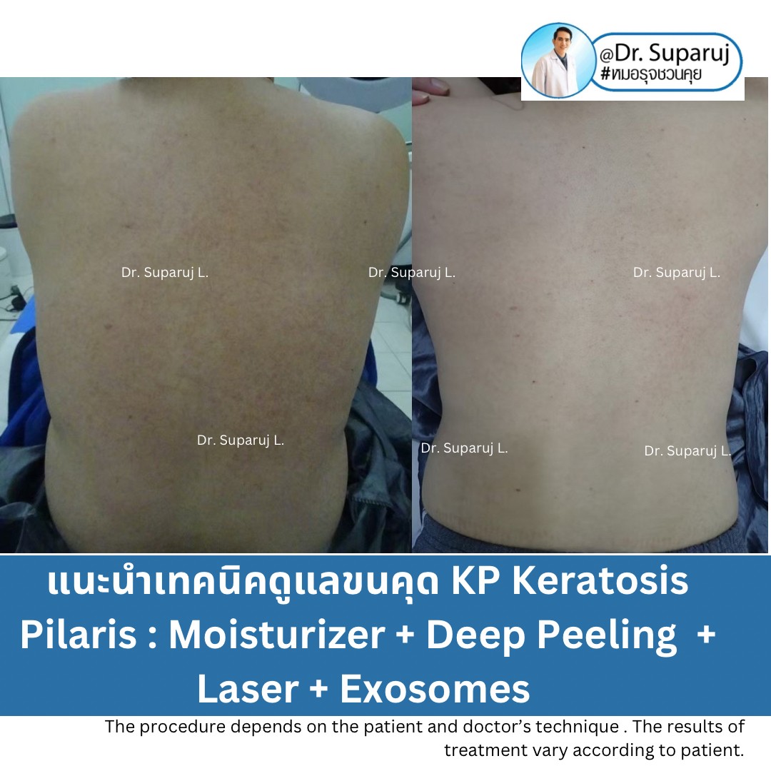 Update ขนคุด Keartosis Pilaris KP เกิดจากอะไร + มีลักษณะอย่างไร + ดูแลได้อย่างไร? Update ขนคุด Keartosis Pilaris KP เกิดจากอะไร + มีลักษณะอย่างไร + ดูแลได้อย่างไร?