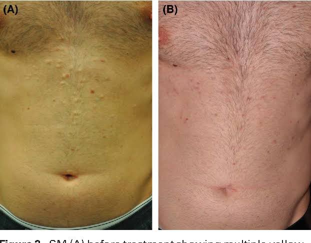 แนะนำเทคนิคดูแล ก้อนซีสต์จากท่อต่อมไขมัน Steatocystoma Multiplex (SM) ด้วย เข็มพลังงานคลื่นวิทยุ Insulated Radiofrequency RF Microneedle for Steatocystoma Multiplex Treatment