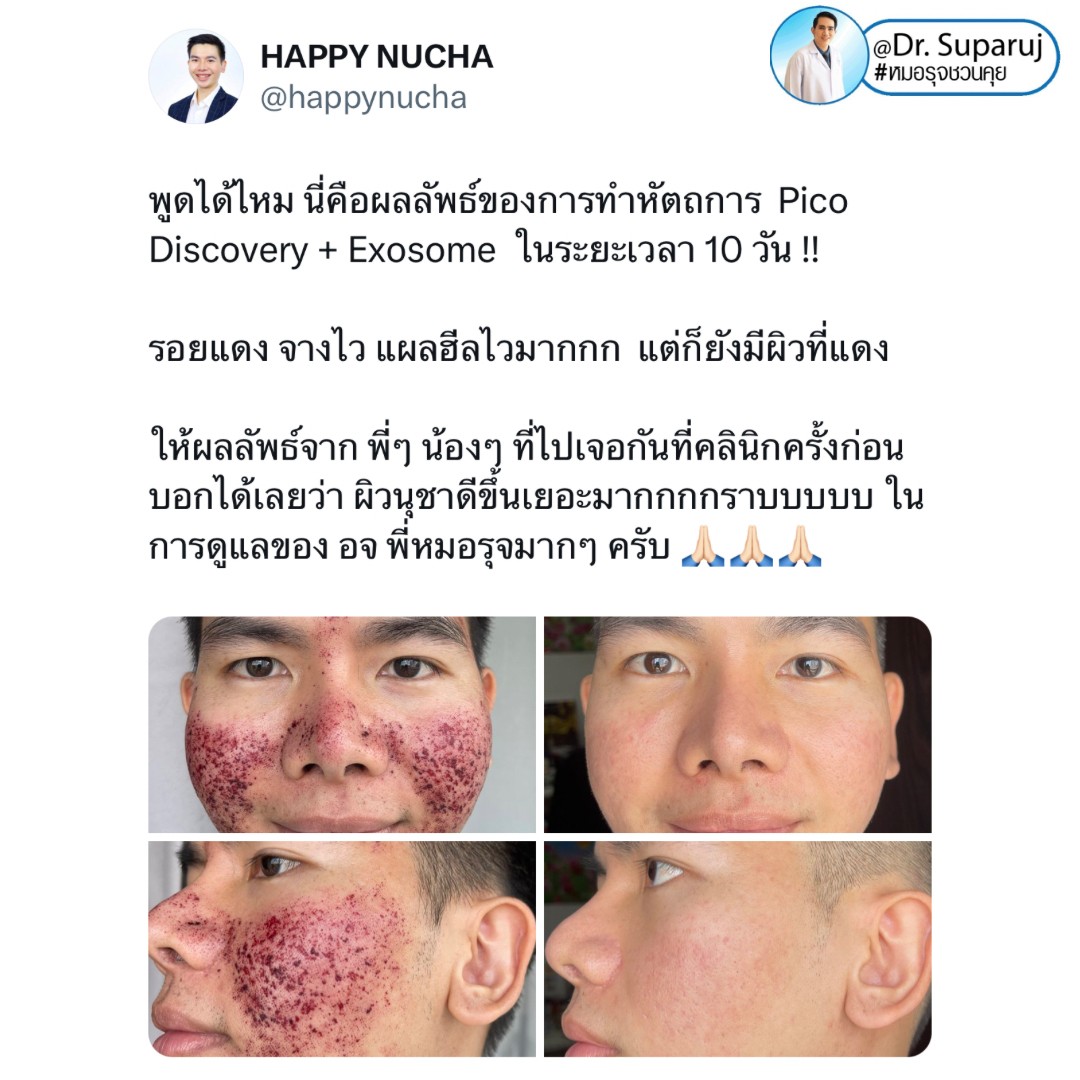 มีสิวอักเสบเม็ดใหญ่ ไม่มีหัว ขึ้น ดูแลอย่างไรดี ? มีสิวอักเสบเม็ดใหญ่ ไม่มีหัว ขึ้น ดูแลอย่างไรดี ?