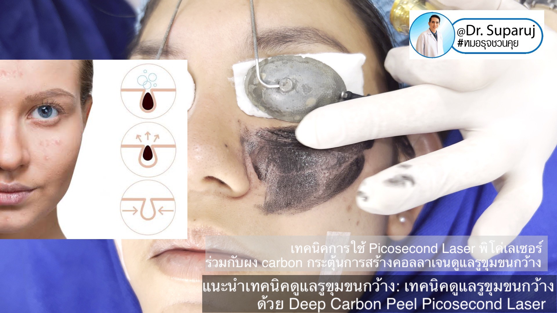 แนะนำเทคนิคดูแลรูขุมขนกว้าง: เทคนิคดูแลรูขุมขนกว้างด้วย Deep Carbon Peel Picosecond Laser (เทคนิคการใช้ Picosecond Laser พิโค่เลเซอร์ ร่วมกับผง carbon กระตุ้นการสร้างคอลลาเจนดูแลรูขุมขนกว้าง )